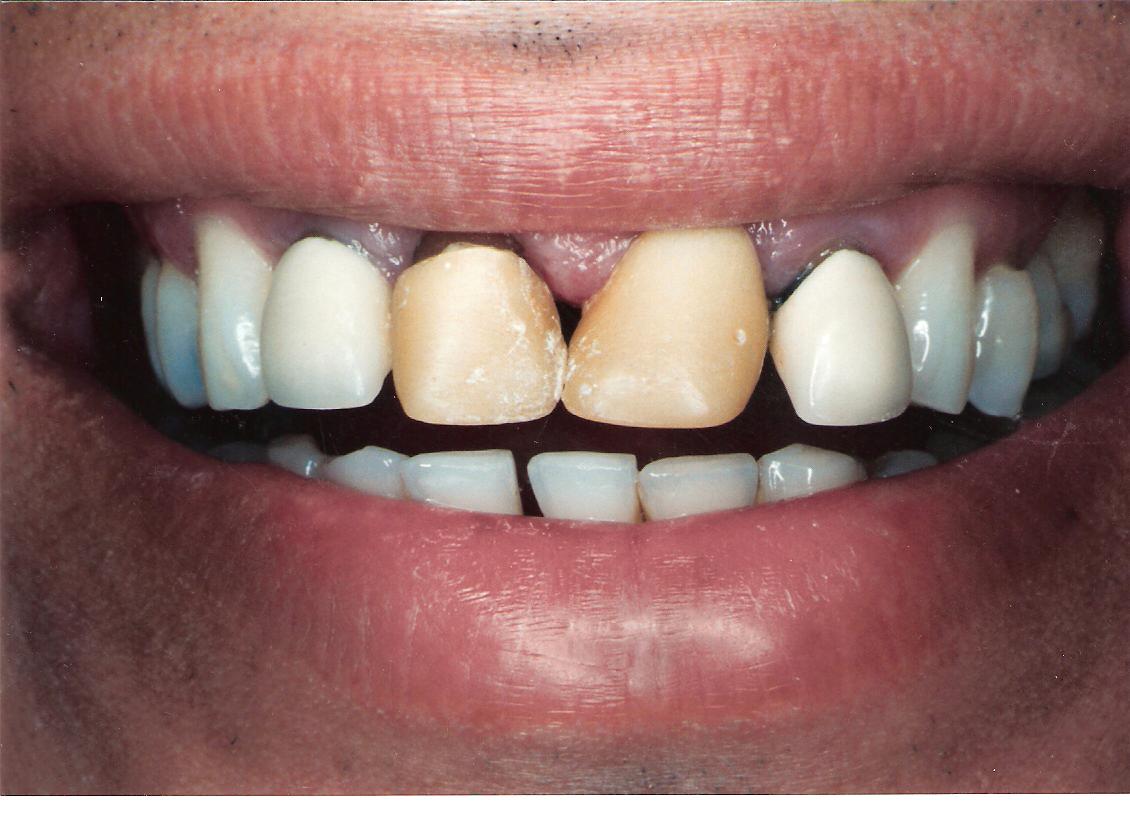 Crowns & Dental Bridges Dental Professionals of Dardenne in MO