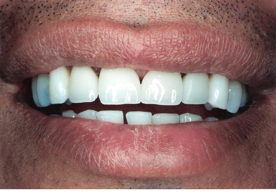 Crowns & Dental Bridges Dental Professionals of Dardenne in MO